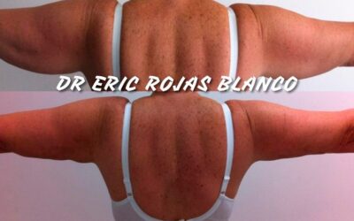 Slim láser en Brazos con el Dr. Eric Rojas Blanco.