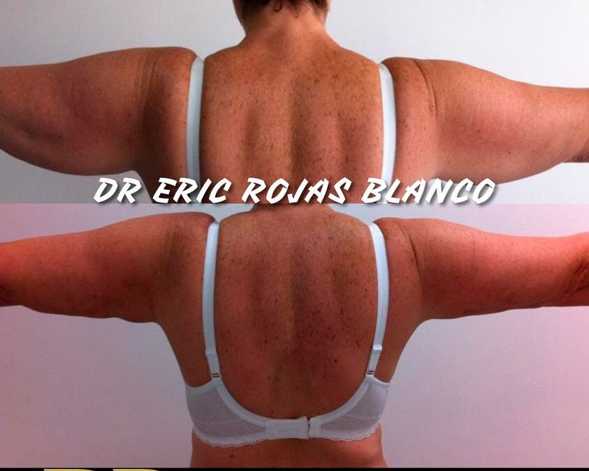 Slim láser en Brazos con el Dr. Eric Rojas Blanco.