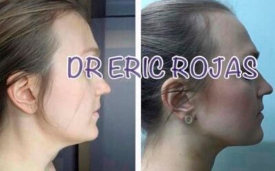 Disminución de papada con el Dr.Eric Rojas.