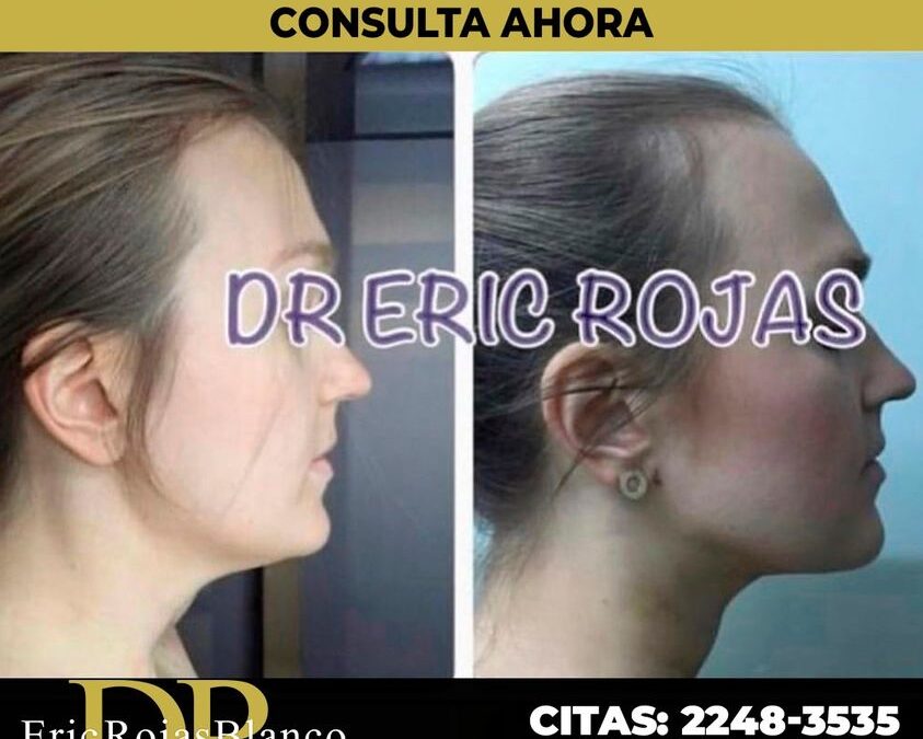 Disminución de papada con el Dr.Eric Rojas.