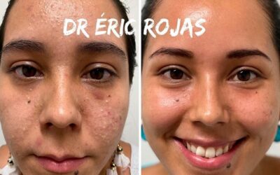 Eliminá tu acné en la dermatología del Dr. Eric Rojas.