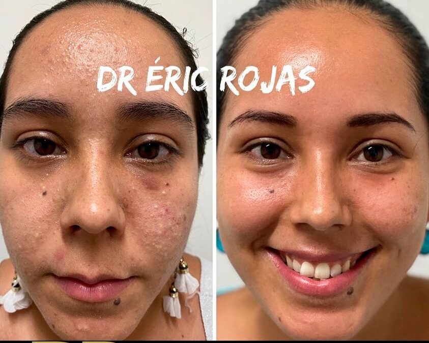 Eliminá tu acné en la dermatología del Dr. Eric Rojas.