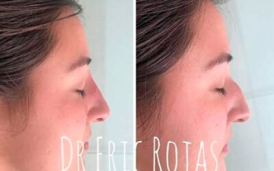 Rinolift con el Dr.Eric Rojas Blanco, nuestros cambios son increíbles.