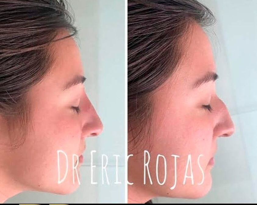 Rinolift con el Dr.Eric Rojas Blanco, nuestros cambios son increíbles.