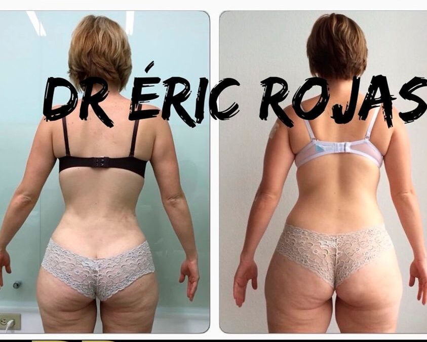 Slim láser, Dr.Eric Rojas Blanco