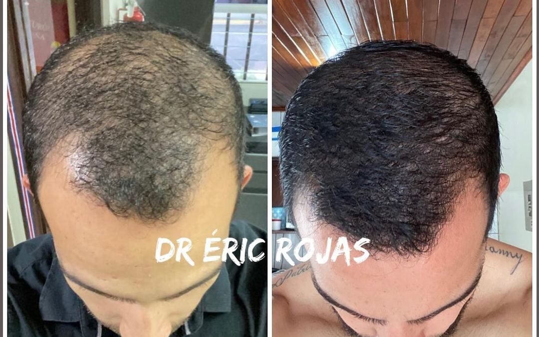 CAÍDA DE CABELLO YA NO MÁ