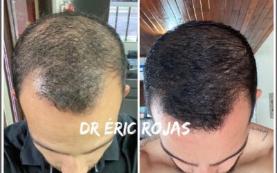 CAÍDA DE CABELLO YA NO MÁ