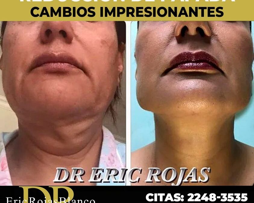 Reducción de papada.
