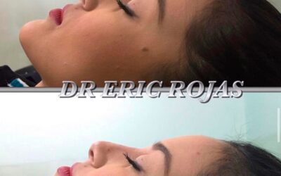 Rinolift con el Dr. Eric Rojas Blanco.