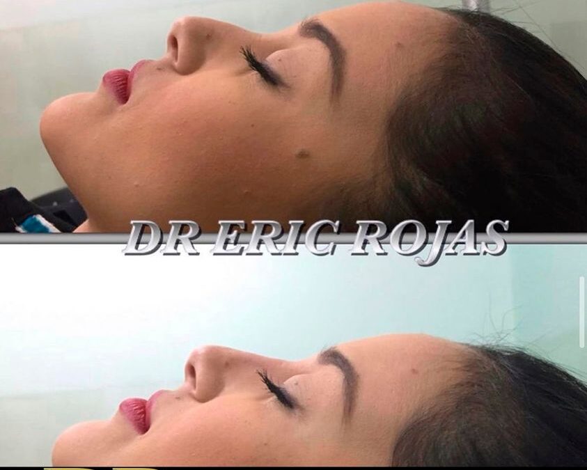 Rinolift con el Dr. Eric Rojas Blanco.