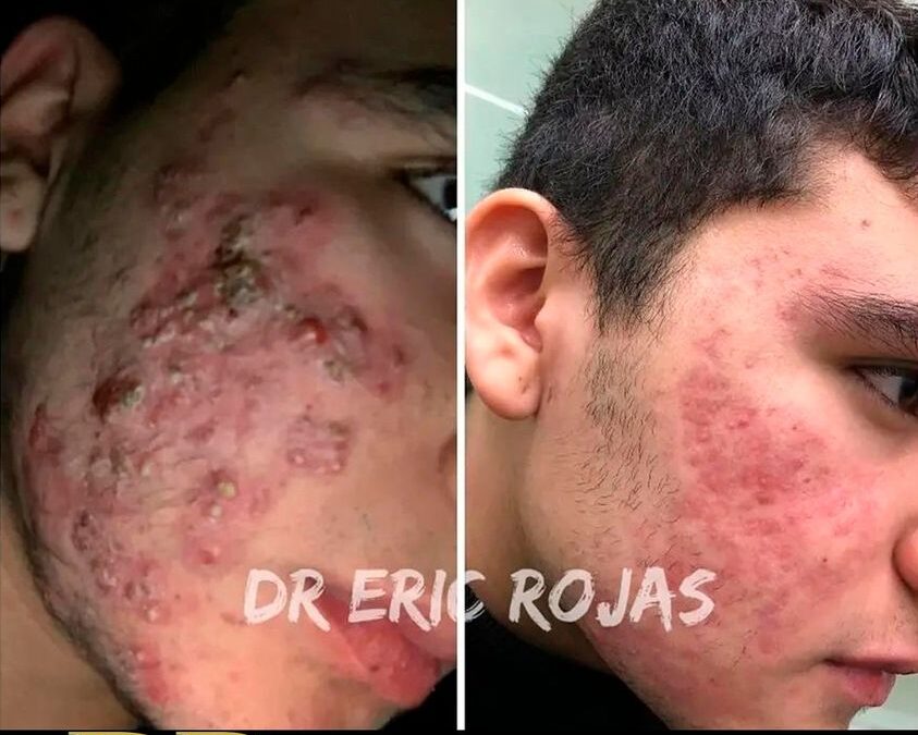 Acné severo, nosotros lo solucionamos.