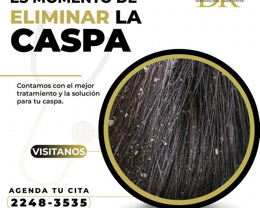 ¡Elimina la caspa!