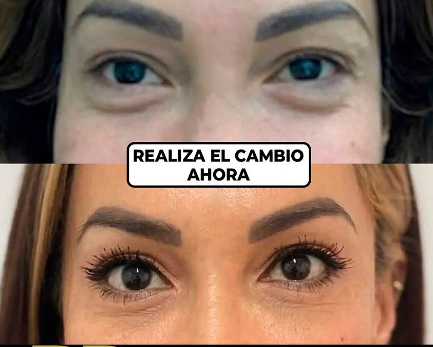 Rejuvenecimiento facial con el Dr.Eric Rojas.