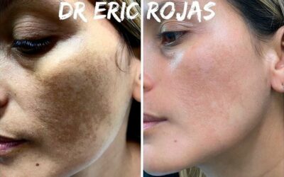 Elimina las manchas del rostro.