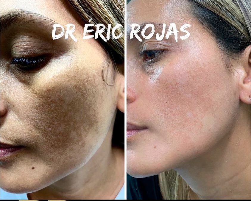 Elimina las manchas del rostro.