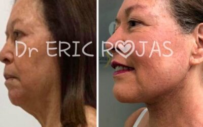 Reducción de papada con el Dr. Eric Rojas.