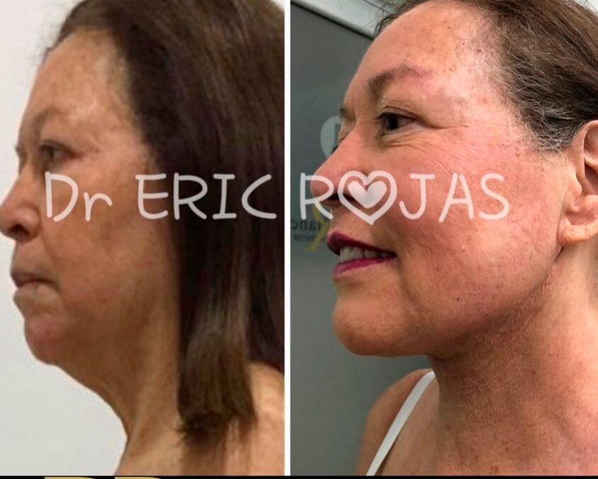 Reducción de papada con el Dr. Eric Rojas.