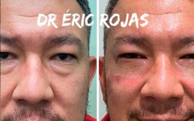 Rejuvenecimiento con el Dr. Eric Rojas.