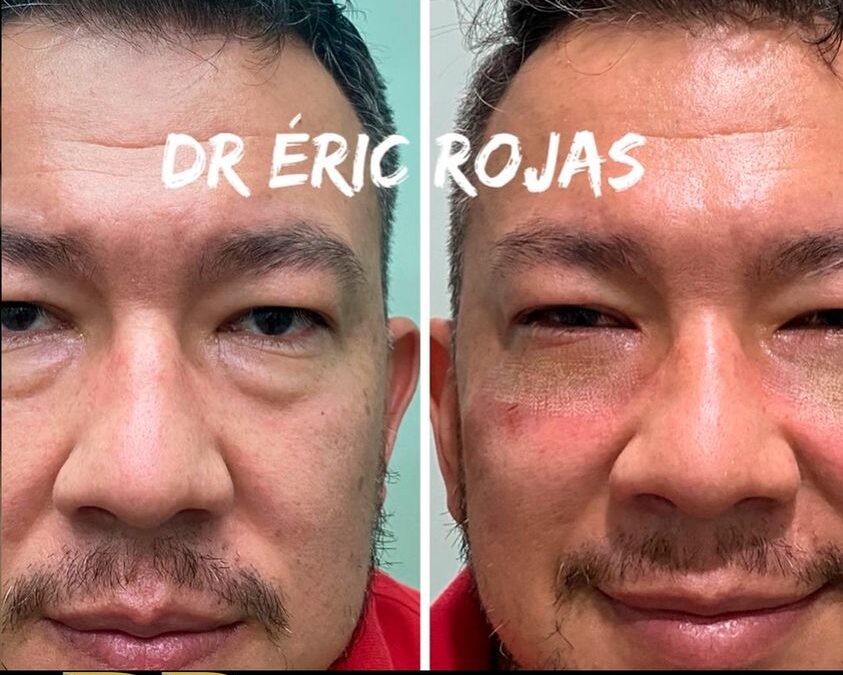 Rejuvenecimiento con el Dr. Eric Rojas.
