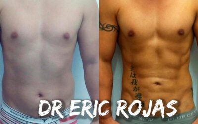 Marcaje de abdomen con el Dr. Eric Rojas.