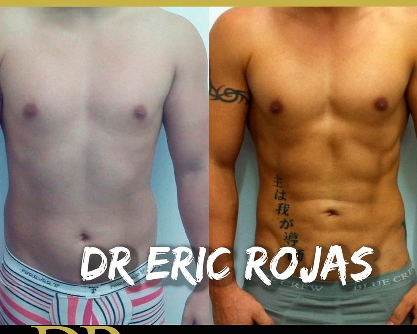 Marcaje de abdomen con el Dr. Eric Rojas.