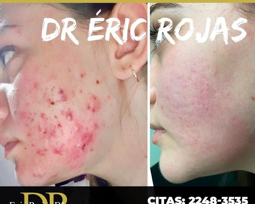 Mereces verte libre de acné, contactanos.