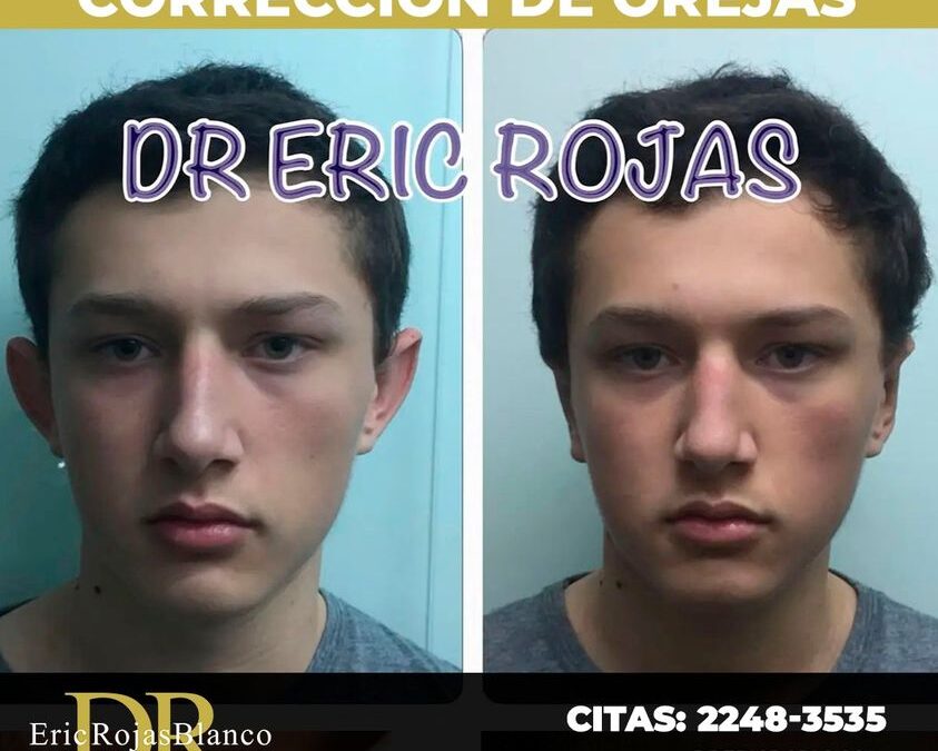 Corrección de orejas con el Dr. Eric Rojas, ¡No espere más!