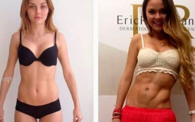Marcaje de abdomen con Slim Láser.