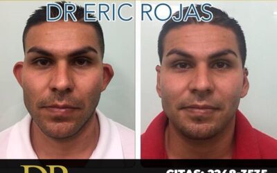 Corrección de orejas con el Dr. Eric Rojas Blanco