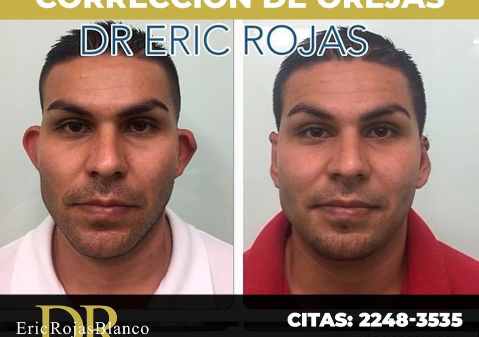 Corrección de orejas con el Dr. Eric Rojas Blanco