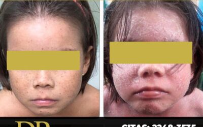 Dermatitis topica solucionado.