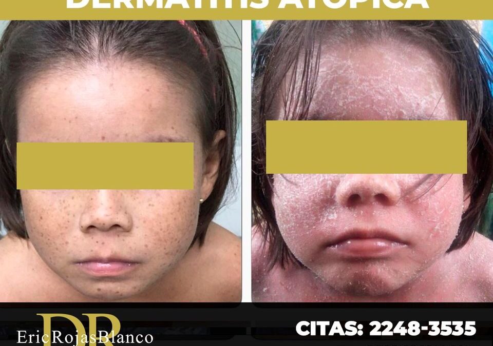 Dermatitis topica solucionado.