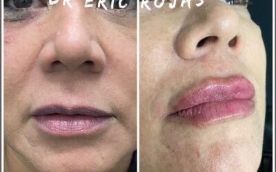 MODELADO DE LABIOS
