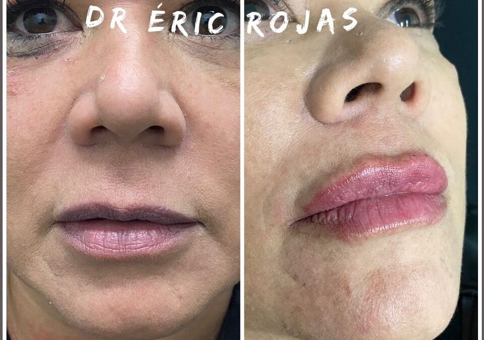 MODELADO DE LABIOS