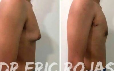 Elimina la ginecomastia con el Dr.Eric Rojas.