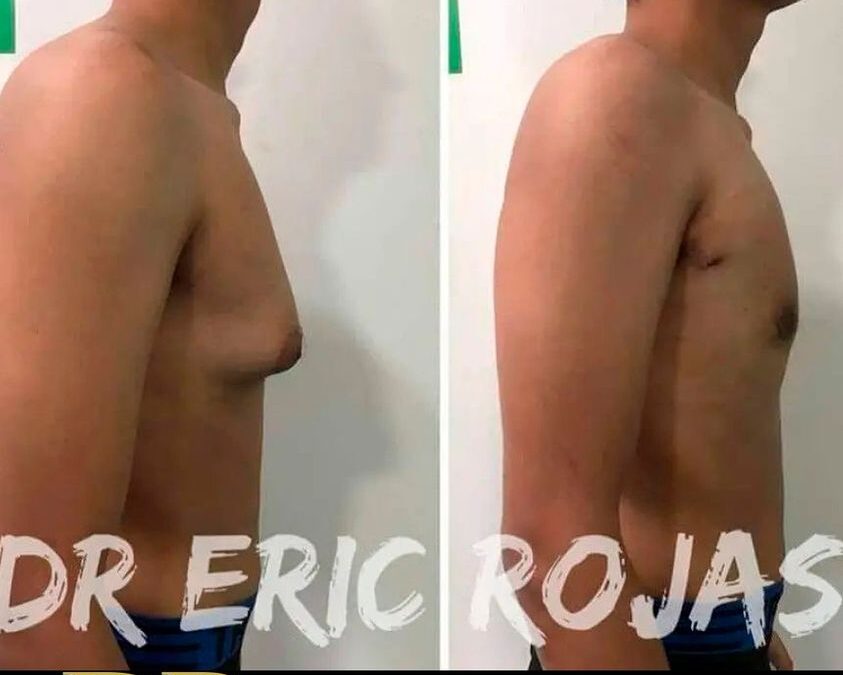 Elimina la ginecomastia con el Dr.Eric Rojas.