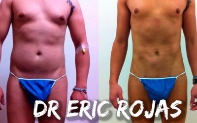 Nuestros increíbles resultados con el Slim Láser.