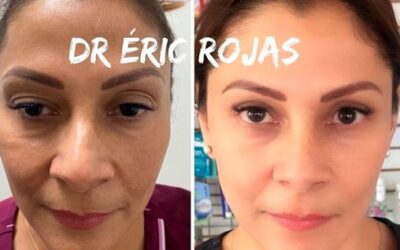 Rejuvenecimiento Facial con el Dr.Eric Rojas.