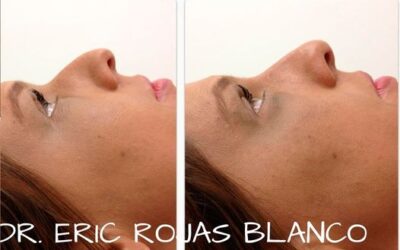 Rino lift con el Dr. Eric Rojas Blanco.