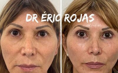 Rejuvenecimiento facial con el Dr. Eric Rojas Blanco.