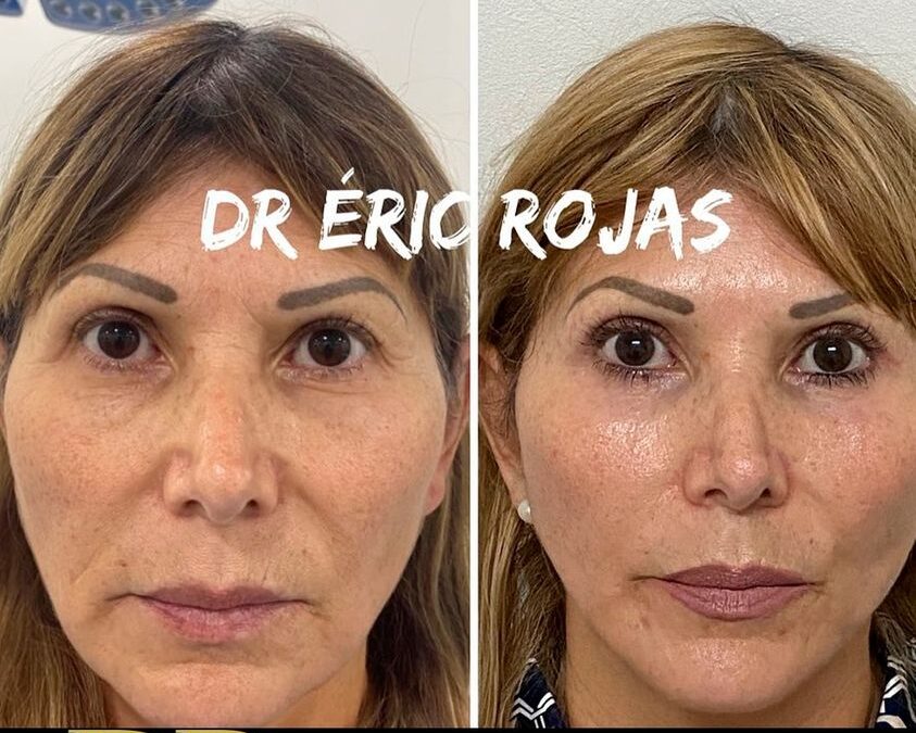 Rejuvenecimiento facial con el Dr. Eric Rojas Blanco.