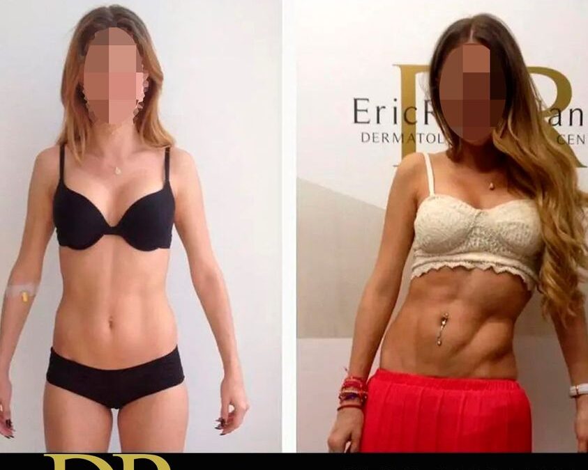 Marcaje de abdomen con el Dr.Eric Rojas.