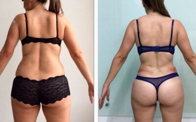 Cambios increíbles con Slim Láser.