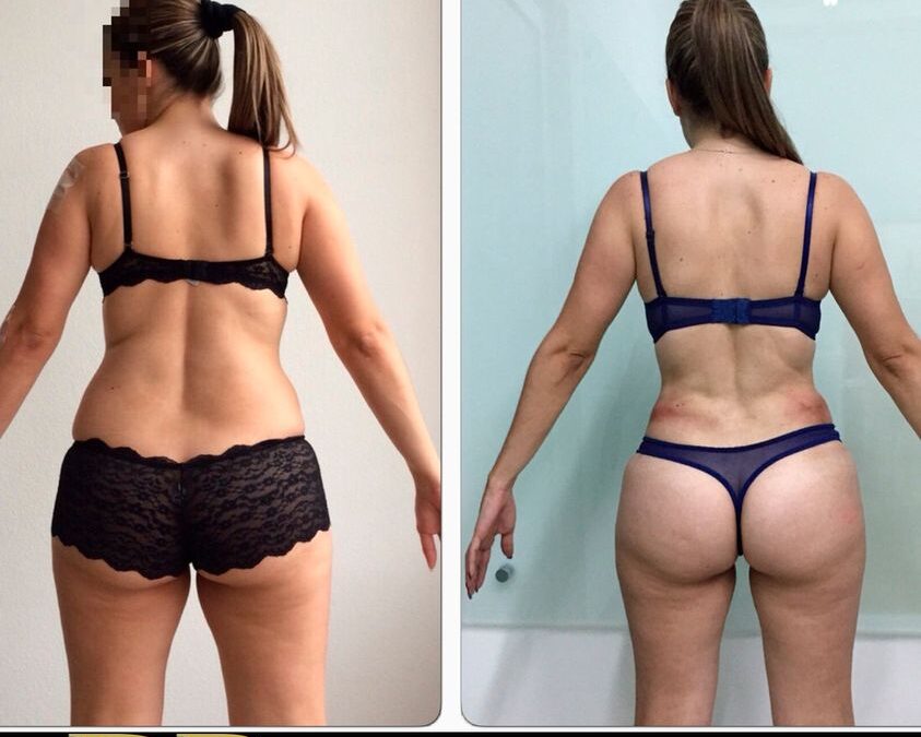 Cambios increíbles con Slim Láser.