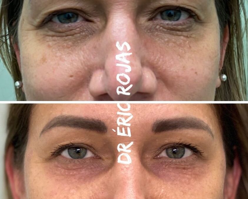 Refrescamiento de párpados DR ÉRIC ROJAS 22483535