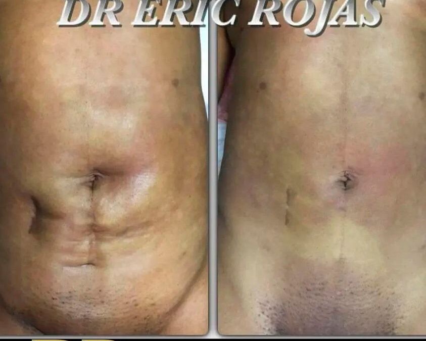 Cesárea, cicatriz de apendicectomía, además de una liposucción anterior.
