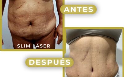 Slim Láser 3 meses después del procedimiento.