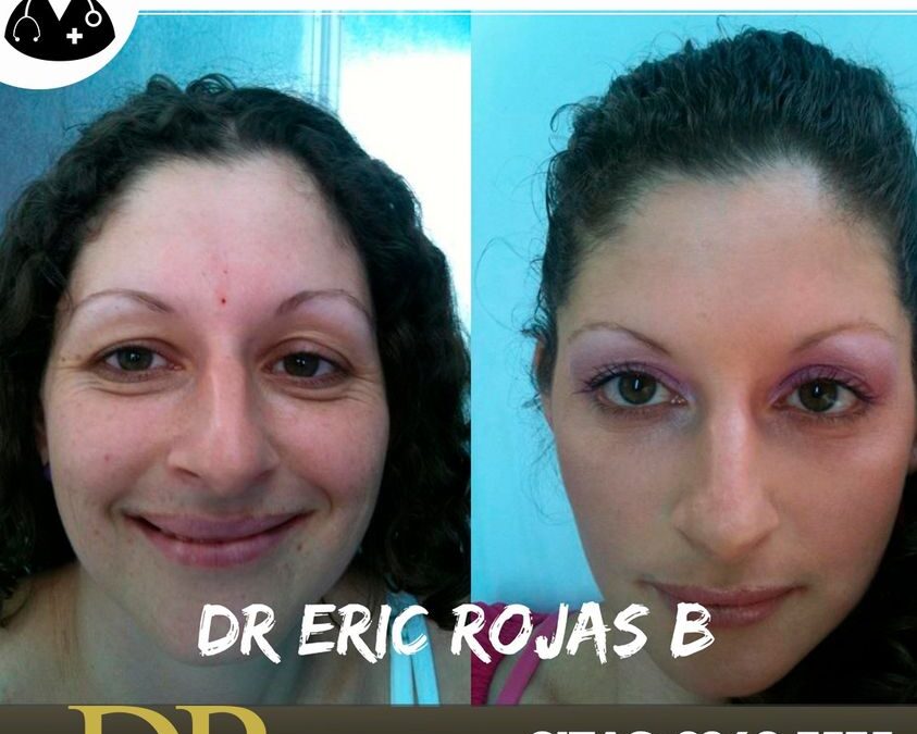 Rejuvenecimiento con el Dr. Eric Rojas.