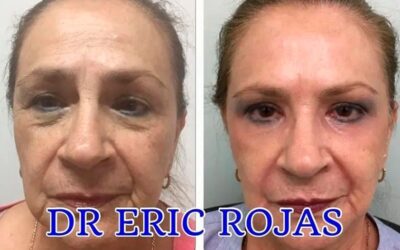 Rejuvenecimiento facial, realizalo ahora.