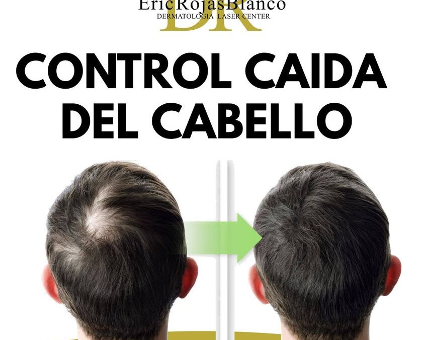 Tenemos la mejor solución para la caida de cabello.